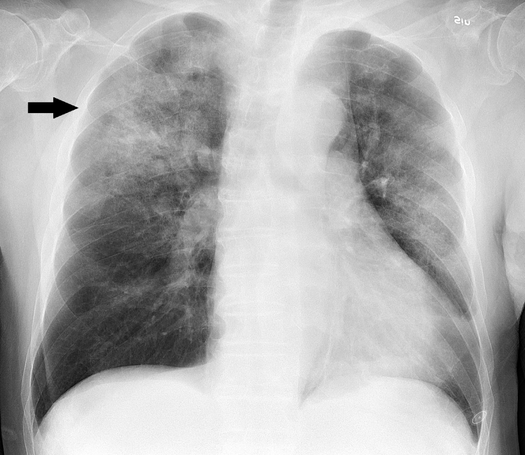 Lungs infected with pneumonia, which causes fluid to accumulate in lungs