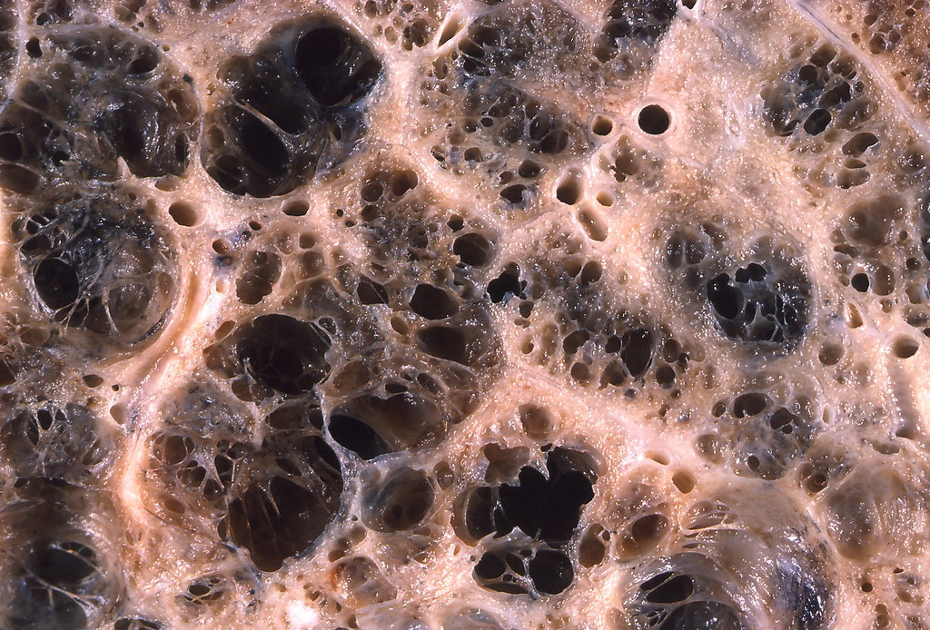 Magnification of a lung infected by emphysema